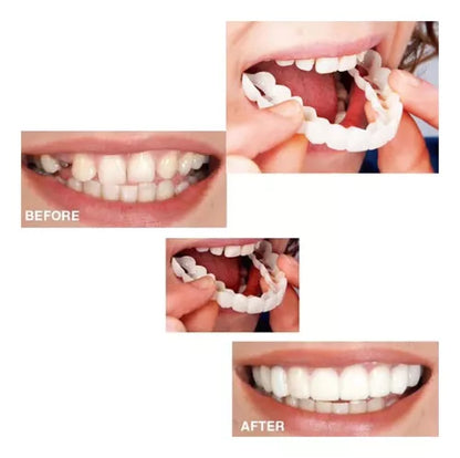 Implantes dentales (Superior+Inferior)